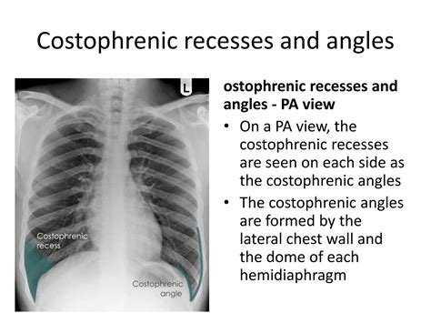 Costophrenic Angle