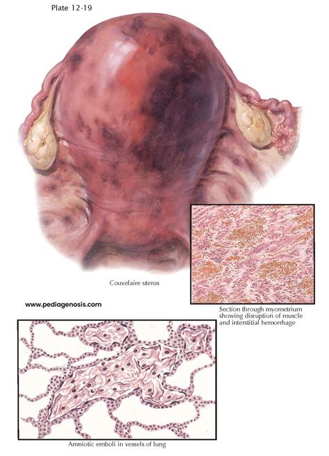 couvelaire uterus 뜻