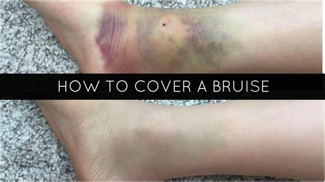 Covering Up Bruises At Work I Compared My Interviewer With My Dog And More - Covering Up Bruises At Work I Compared My Interviewer With My Dog And More