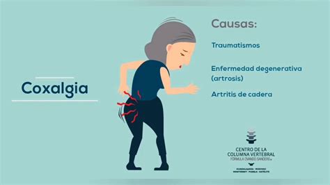 Coxalgia Que Es