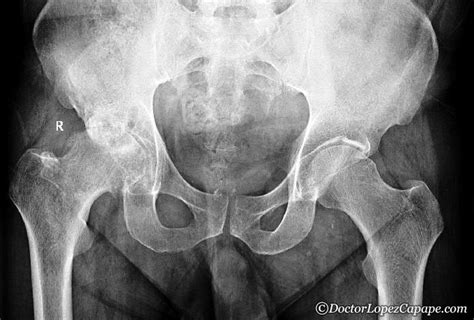 Coxartrosis De Cadera