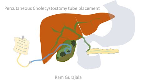 cpt code for cholecystostomy tube placement - baghastore.com