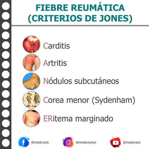 Criterios De Jones