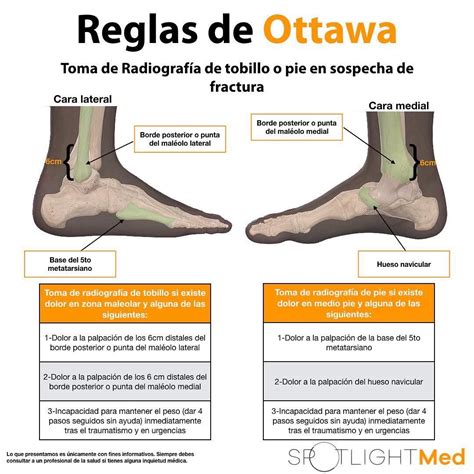 Criterios De Ottawa