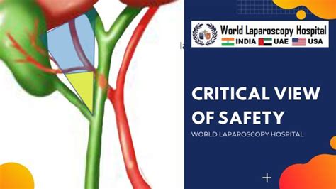Critical View Of Safety