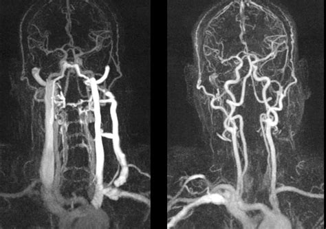 Ct Angiogram For The Head And Neck Quizlet