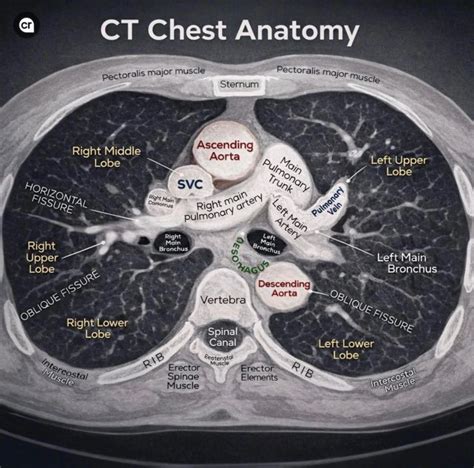 Ct Chest Thorax