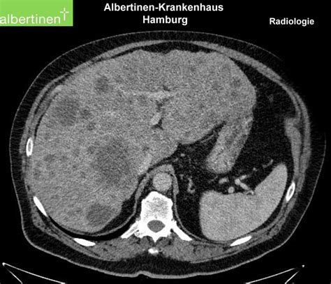 ct mit leberwurst mit metastasen