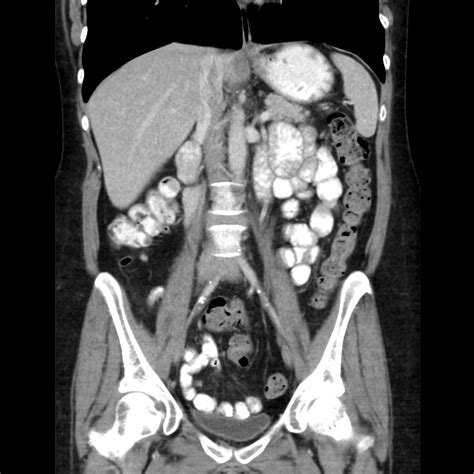 Ct Scan Of Abdomen