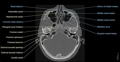 Ct Sinus Bones Labeled