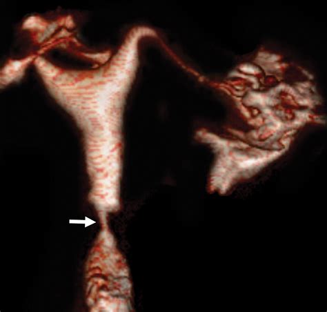 Ct Virtual Hysterosalpingography