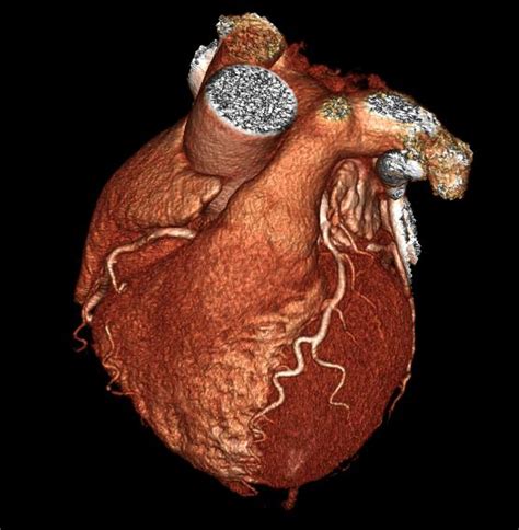 Read Ct Of The Heart 