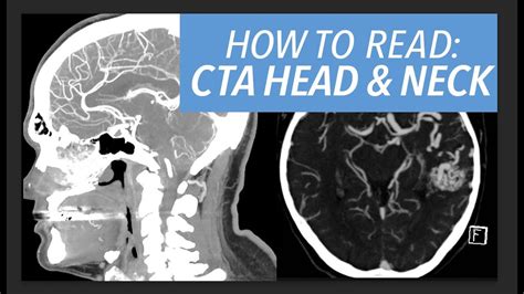 Cta Head And Neck