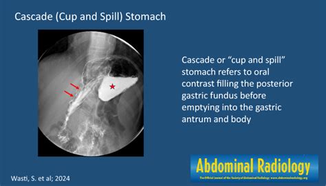 cup-and-spill stomach - Academic Dictionaries and Encyclopedias