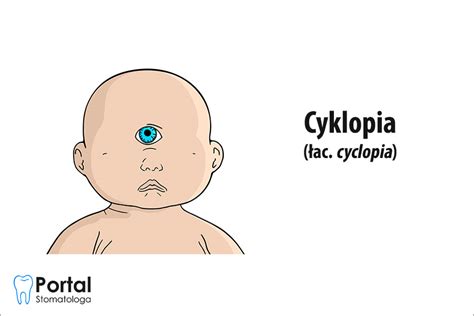 Cyklopia U Ludzi