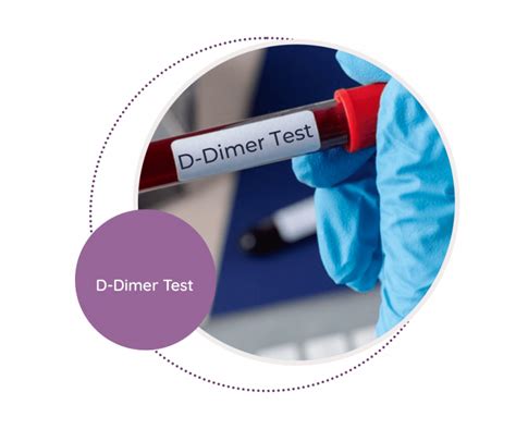 Download D Dimer Testing New Clsi Guidelines 