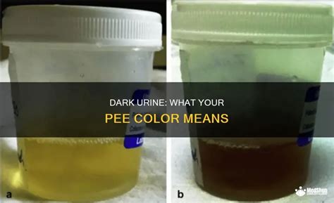 dark colored urine