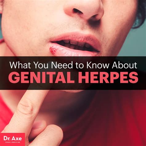 dating a woman with genital herpes