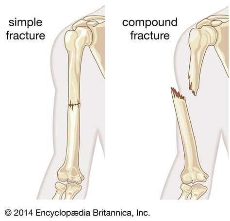 dating fractures in adults