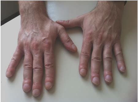 Dedos De Tambor