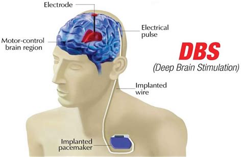 Deep Brain Stimulation Indications And Applications