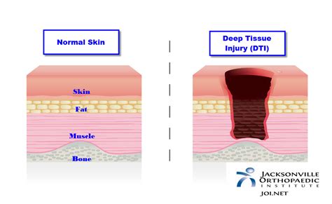 deep deep tissue