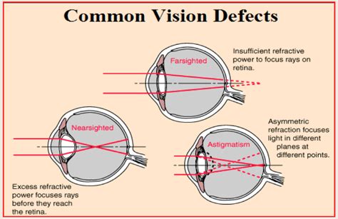 Defects Of Vision