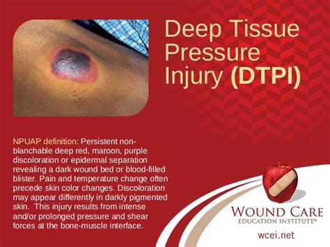 define deep tissue injury by npuap