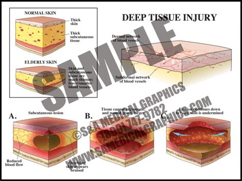 define fissue tissue injury syndrome