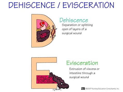 Define Eviscerate