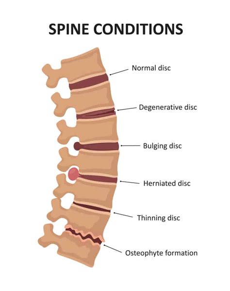 The discs can herniate, or bulge out, and c