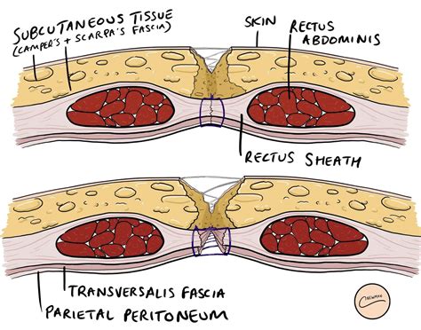Dehiscence