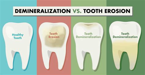 Demineralization Of Teeth