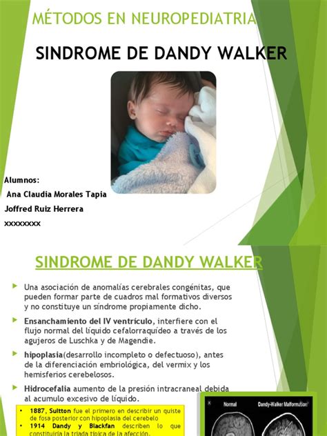 dendy walker sindrome PDF