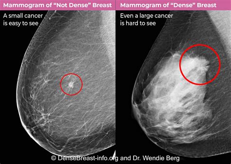 Dense Breast Icd 10