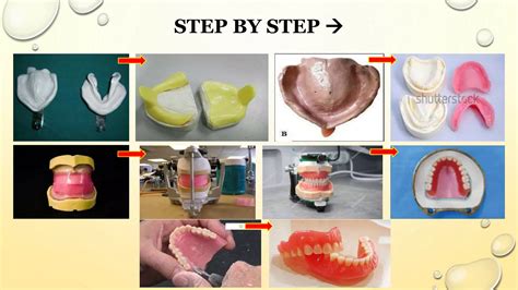 Dental Laboratory Procedures Complete Dentures Split Cast