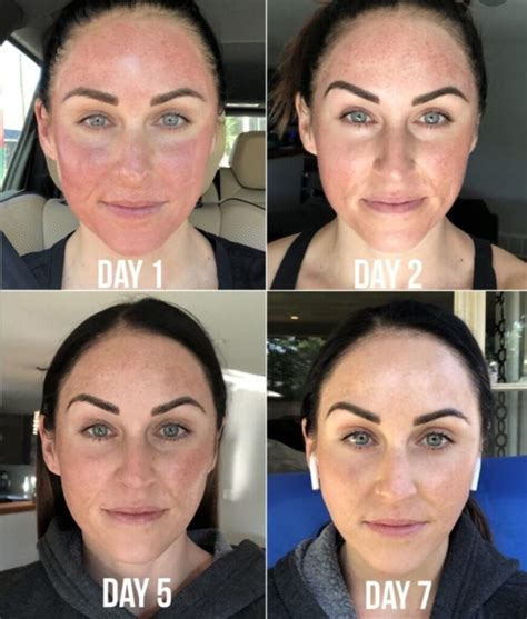 dermapen resultat rynkor