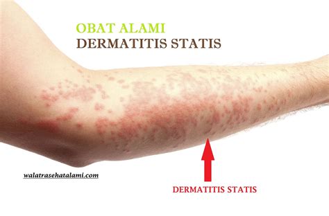 dermatitis adalah
