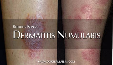 dermatitis numularis