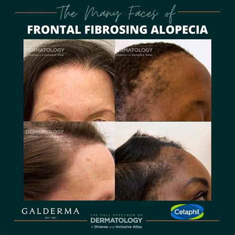 Read Dermatology Department Frontal Fibrosing Alopecia 