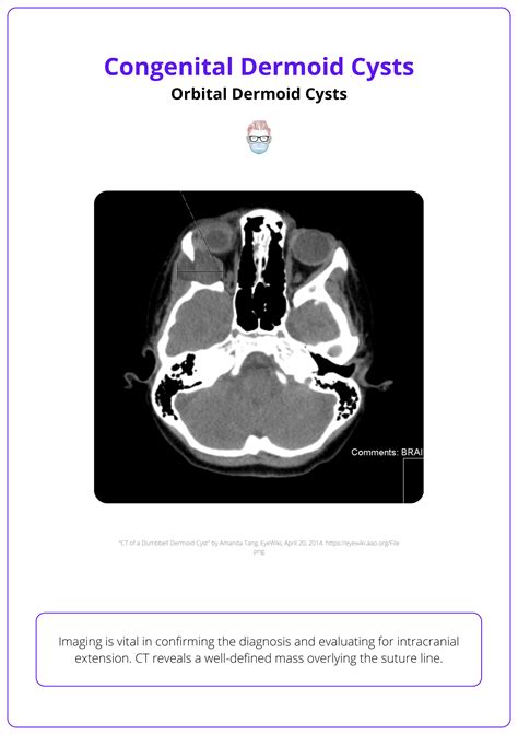 Dermoid Cyst Bcpa