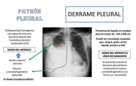 Derrame Pleural Radiografía