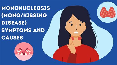 describe kissing disease symptoms chart