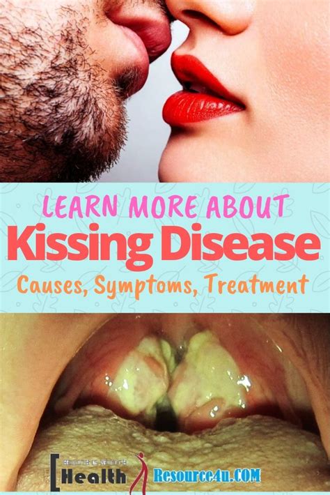 describe kissing disease symptoms pictures
