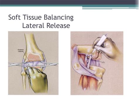 describe soft tissue release mechanism