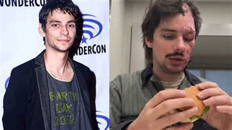 Devon Bostick Face Burn