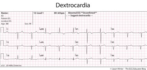dextrocardia ecg