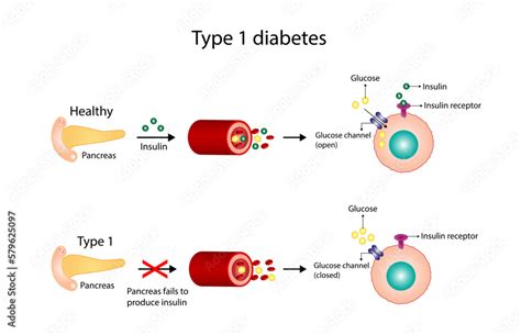 diabetes 1