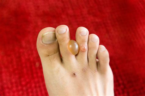 Diabetic Blisters On Feet