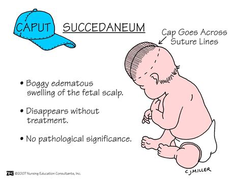 Difference Between Caput Succedaneum And Cephalohematoma